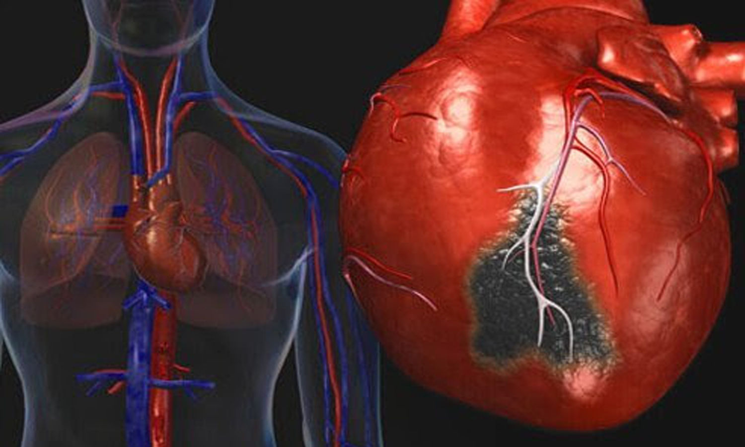 radial artery coronary graft