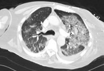 ct scan of chest